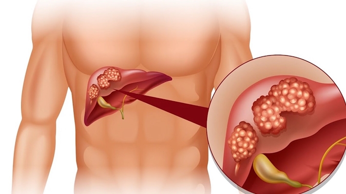 Bệnh viện CATP : Bệnh viêm gan do Virus - Những điều cần biết để phòng ngừa hiệu quả